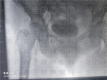 外阴癌：常见于绝经女性
