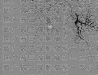 外阴皮肤瘙痒?不要害羞，警惕外阴癌