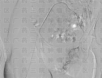 外阴癌手术成功率高吗?广药三院肿瘤科一区