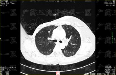 乳腺癌医生让做微创，有用吗?