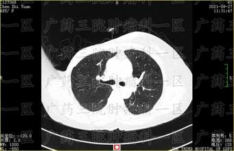 良性乳腺增生与恶性乳腺癌之间，究竟有多远