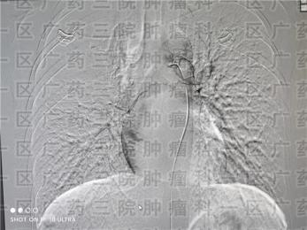 骨肉瘤疼痛还肿胀?