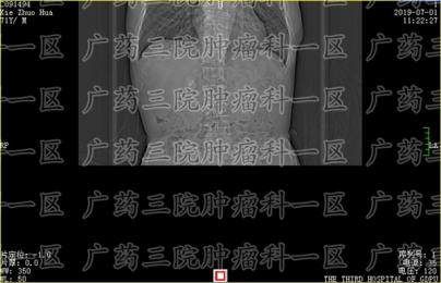 肝癌微波消融术多少钱一次?广药三院肿瘤科