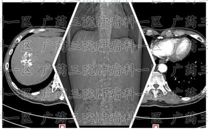 肝细胞癌做微波消融手术有效果吗?