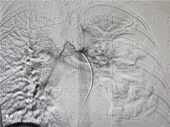 肺癌脑转移怎么治?