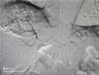“打一针”治疗9厘米巨肝癌