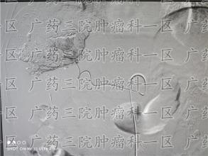 将近一半的癌症病人都存有营养不良