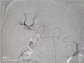肝癌用什么方法治疗好？