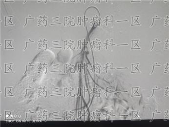 淋巴癌肝转移可以治好吗