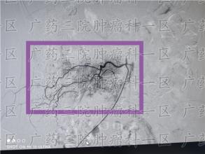 身体太虚，宫颈癌还有出路吗？