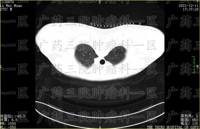 肺癌肺不张严重吗?广药三院肿瘤科一区彭齐