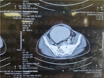 肠癌晚期转移到骶骨怎么止痛?