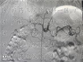 胃癌复发转移诊治中的难点及对策