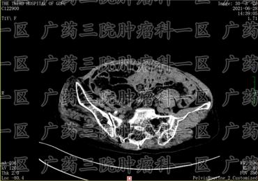 卵巢癌手术后还需要治疗吗?