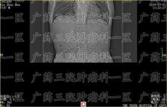 临考小孩突然腹痛，一查却是肝癌？小小年纪