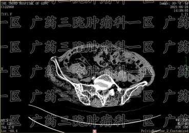 卵巢癌选微创还是选手术?广州复大医疗医院