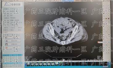 得了癌症，活得好才是硬道理