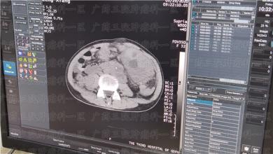 父母得了癌症，子女到底要不要全力治疗？