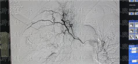 把握治疗胃癌好时机，助力消化道肿瘤患者健