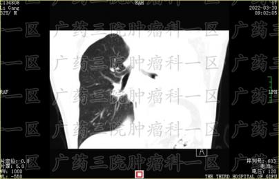 三个征兆说明已有胃癌，现代医院广药三院肿