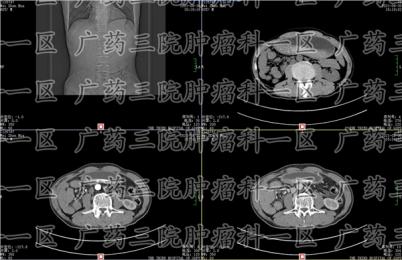 胃癌晚期疼痛难忍怎么办?现代医院广药三院