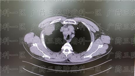 中央型肺癌真的一定要全切吗