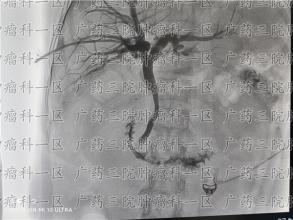 年纪太大，害怕耐受不住放化疗，该怎么办