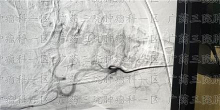 无论是哪种癌症，复发转移都会有这些信号