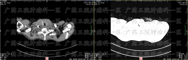 超一半的癌症患者死于复发转移