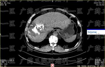 为什么做了癌症治疗，术后还会复发？