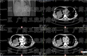 明明在吃靶向药，肿瘤却还在长大？