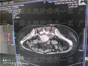 都说癌症患者要运动，应该如何锻炼？