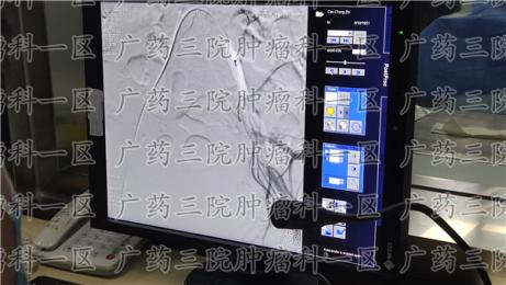 食管癌综合治疗真的有用吗?和谐医院综合方