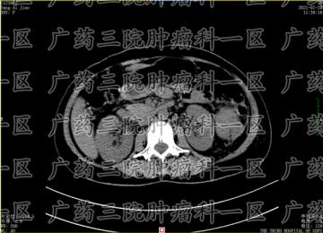 肺癌做化疗就能治好吗?现代医院医生回答