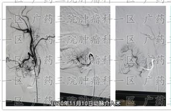 胆管癌，你对它了解多少？到底有多危险？