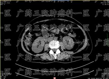 胃窦腺癌的病情严重吗?御生堂中医院：进展