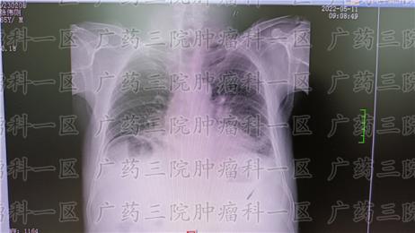 不是学医的肺癌患者如何判断骨转移?现代医