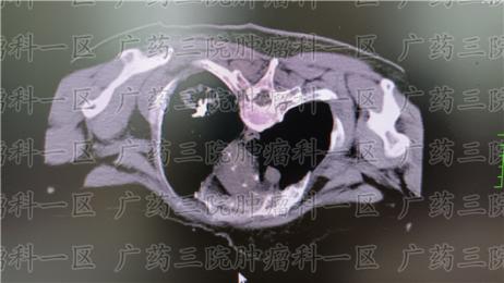 肺癌骨转移粒子植入多久起效?现代医院