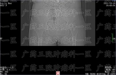 确诊膀胱癌几个月从早期到中晚期。复大医疗