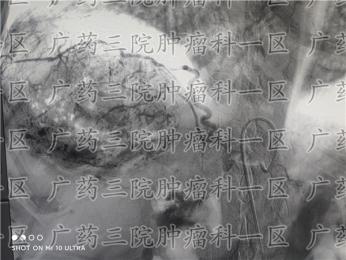 肝癌发病快吗?泰和肿瘤医院彭齐荣：肝癌不