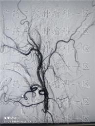 鼻咽癌听力下降能恢复吗?广药三院肿瘤科一