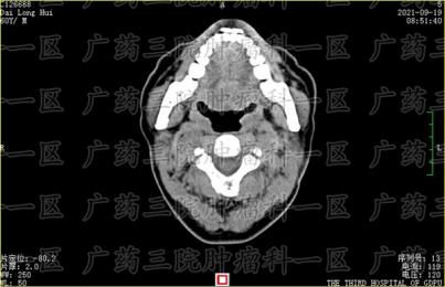 鼻咽癌转移严重吗?仁爱天河医院尽快治疗
