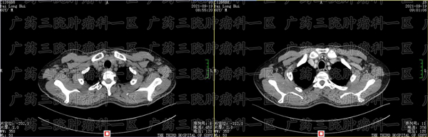 鼻咽癌能做微创手术吗?御生堂中医院
