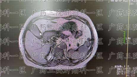 胃窦腺癌手术有用吗?御生堂中医院怎么治