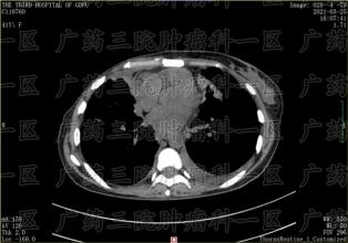 乳腺癌复发转移怎么办？还能治好吗？