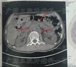 吞水都会痛？鼻咽癌患者放疗有副作用怎么办