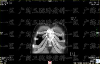 鼻咽癌早期有七个征兆，你知道吗？