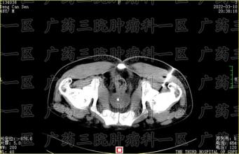癌痛也是一种病，忍一忍，真不行
