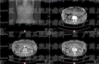 腰疼几个月查出肝癌，这让李大爷一家十分震