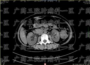 摸到自己脖子淋巴结肿大，会不会是淋巴瘤？